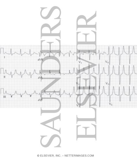 Watermarked preview of unlabeled image: Changes Associated With Hyperkalemia