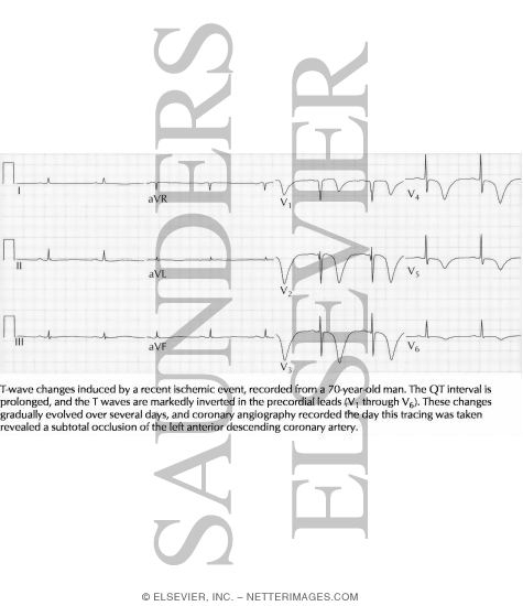 Watermarked preview of labeled image: T-Wave Changes Induced By a Recent Ischemic Event