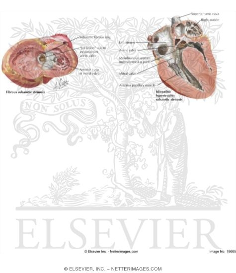 Anomalies of the Left Ventricular Outflow Tract