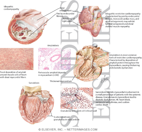 Watermarked preview of labeled image: Idiopathic and Infiltrative Causes of Restrictive Cardiomyopathy