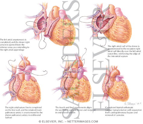 Technique of Orthotopic Biatrial Cardiac Transplantation