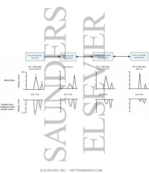 Watermarked preview of labeled image: Echo-Doppler Criteria for Assessment of Diastolic Function