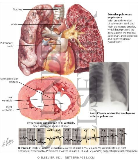 Watermarked preview of labeled image: Chronic Cor Pulmonale
