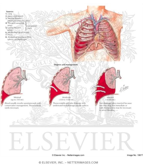 Hemothorax
Sources of Hemothorax