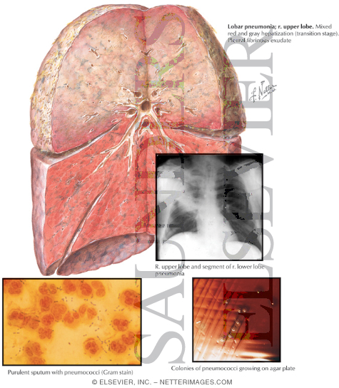 Pneumococcal Pneumonia