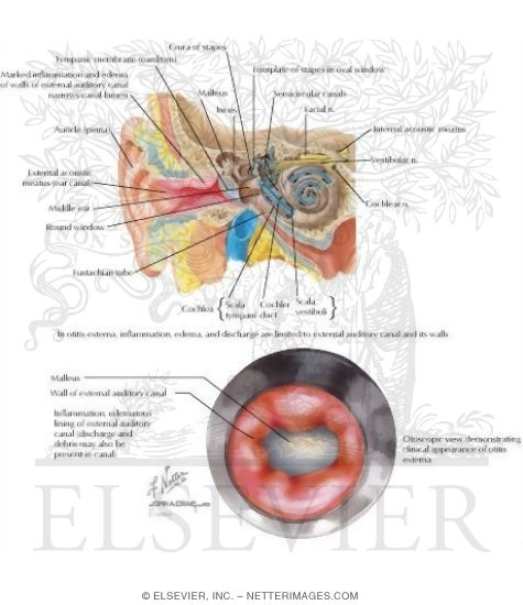 Acute Otitis Externa
