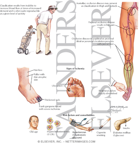 Watermarked preview of labeled image: Lower Extremity Arterial Occlusive Disease