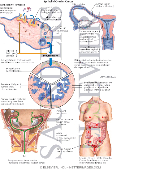 Watermarked preview of labeled image: Epithelial Ovarian Cancer