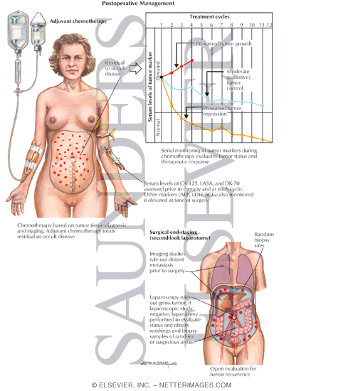 Watermarked preview of labeled image: Postoperative Management of Ovarian Cancer