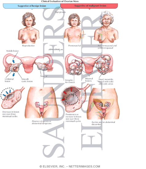 Watermarked preview of labeled image: Clinical Evaluation of Ovarian Mass