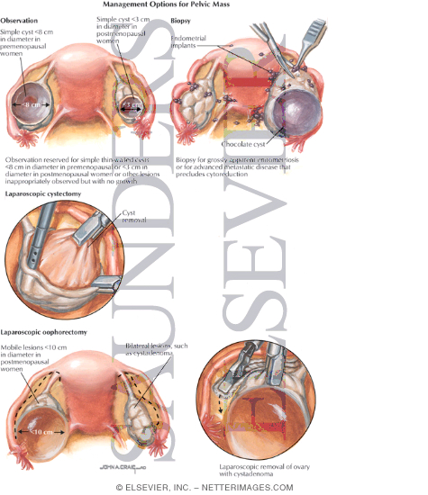 Watermarked preview of labeled image: Management Options for Pelvic Mass