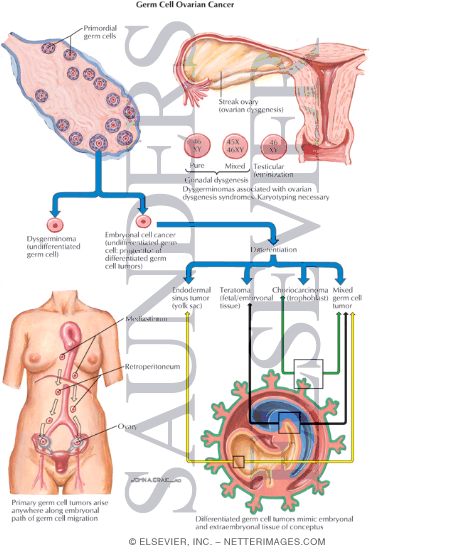 Germ Cell Ovarian Cancer