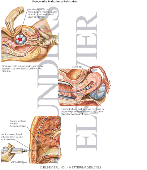 Watermarked preview of labeled image: Preoperative Evaluation of Pelvic Mass