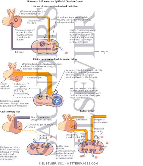 Watermarked preview of labeled image: Hormonal Influences on Epithelial Ovarian Cancer