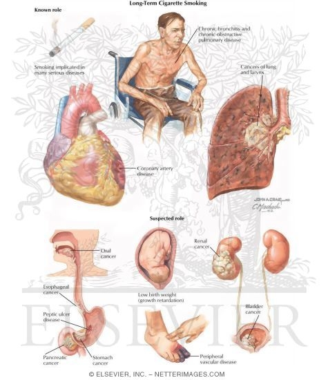 Watermarked preview of labeled image: Long-Term Cigarette Smoking