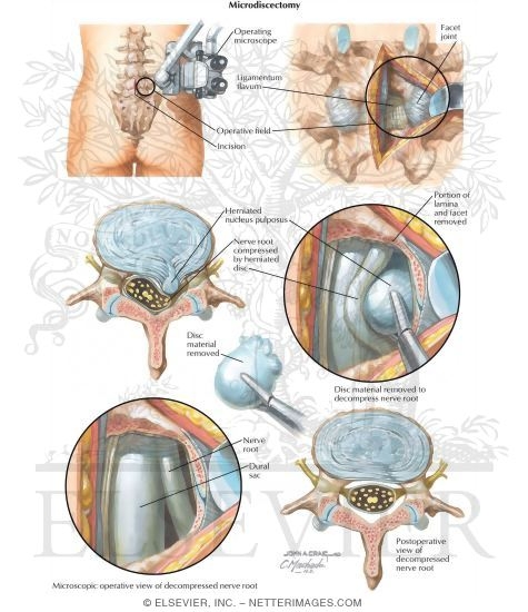 Microdiscectomy