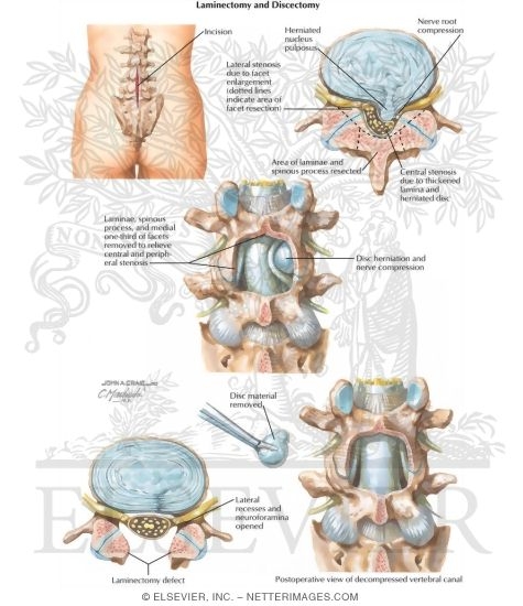 Watermarked preview of labeled image: Laminectomy and Discectomy