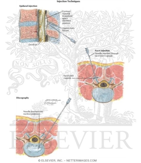 Watermarked preview of labeled image: Injection Techniques