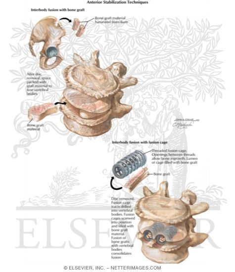 Watermarked preview of labeled image: Anterior Stabilization