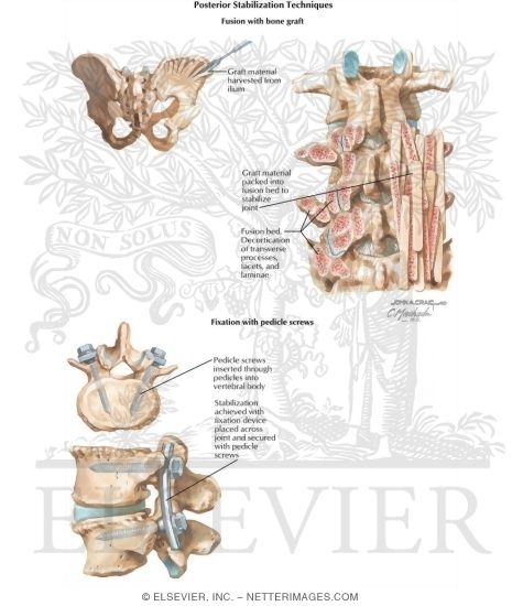 Watermarked preview of labeled image: Posterior Stabilization Techniques
