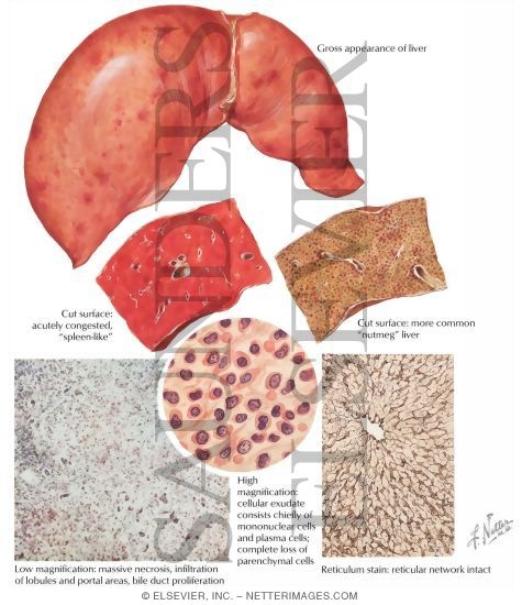 Viral Hepatitis: Fulminant Form (Acute Massive Necrosis)
