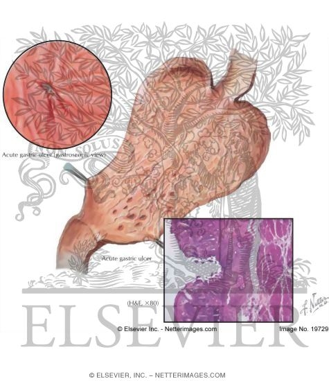 Watermarked preview of labeled image: Peptic Ulcer I - Acute Gastric Ulcer