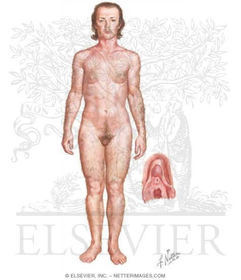 Clinical Manifestations of Hyperandrogenism