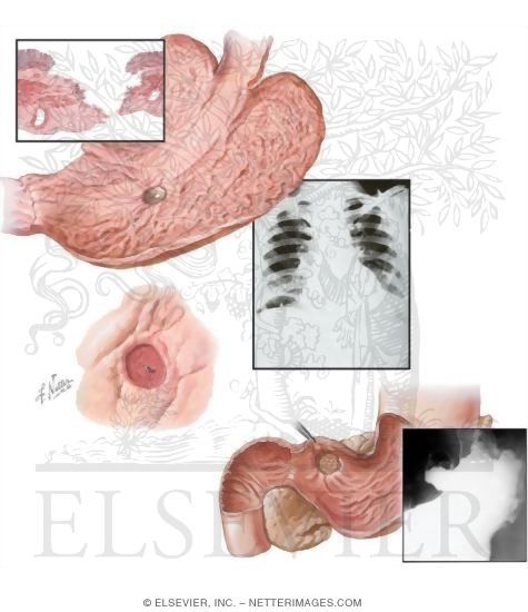 Peptic Ulcer Disease: Complications of Gastric and Duodenal Ulcers