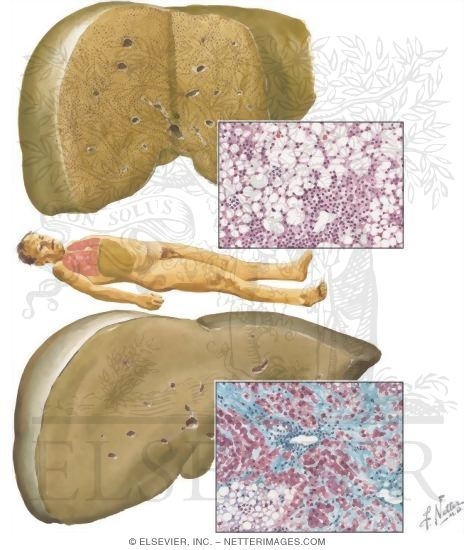 Watermarked preview of unlabeled image: Nutritional Liver Diseases: Nonalcoholic Fatty Liver Disease