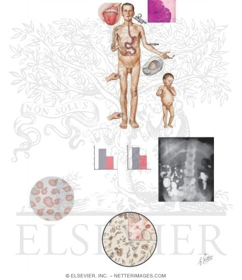 Watermarked preview of unlabeled image: Advanced Malabsorption Syndrome