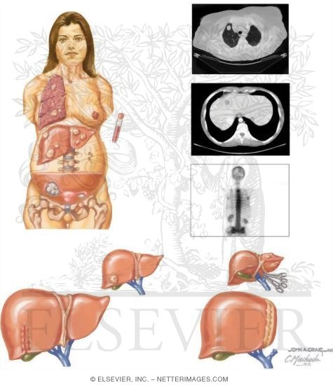 Watermarked preview of unlabeled image: Metastasis In Colorectal Cancer