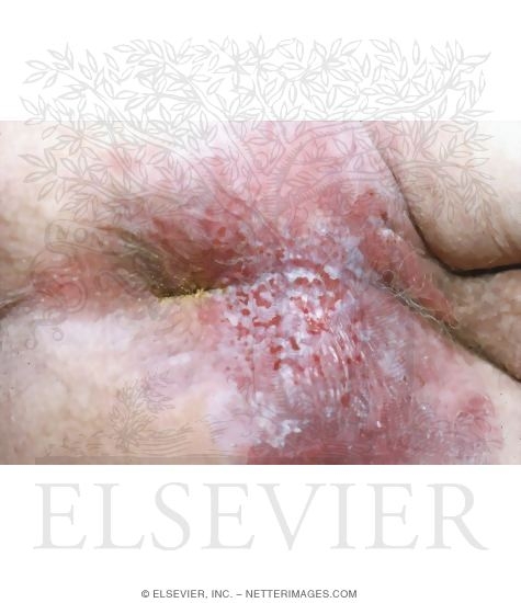 Bowen's Disease