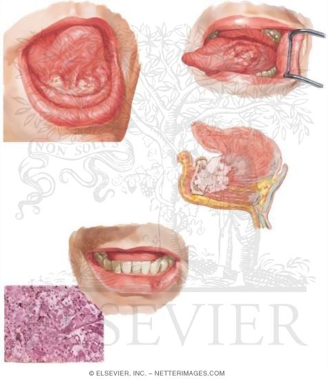 Malignant Tumors of Oral Cavity