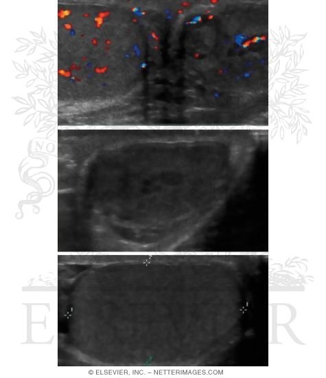 Watermarked preview of unlabeled image: Ultrasound Findings In the Testicle