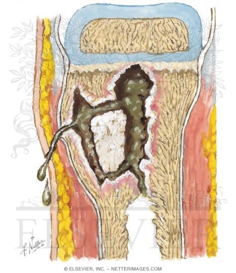 Watermarked preview of unlabeled image: Chronic Osteomyelitis Involving the Metaphysis of the Tibia
