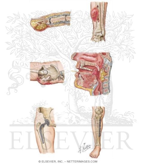 Watermarked preview of unlabeled image: Examples of Contiguous Infections That May Be Associated With Osteomyelitis
