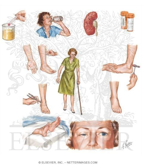 Watermarked preview of unlabeled image: Peripheral Neuropathy Caused By Heavy Metal Poisoning