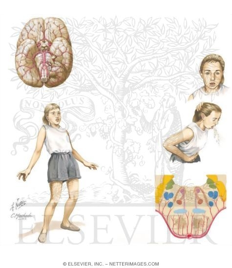 Basilar Artery Migraine