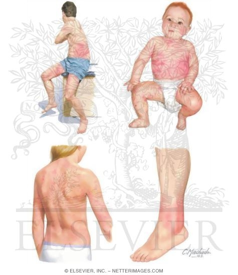 Watermarked preview of unlabeled image: Cutaneous Findings In Disorders of the Immune System