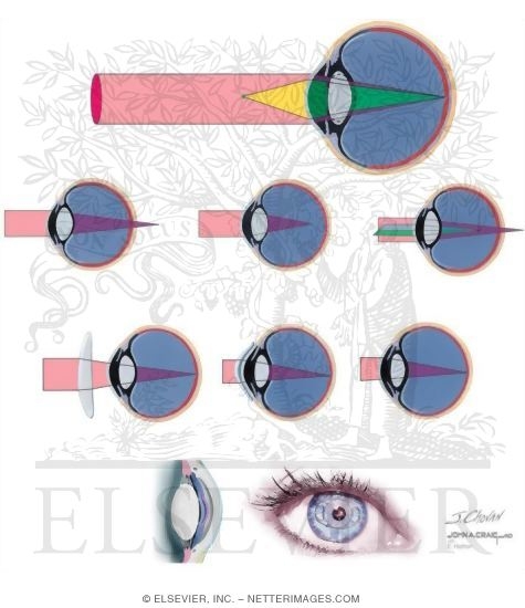 Myopia and Other Refractive Errors