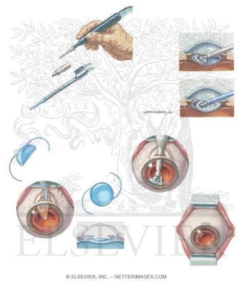 phacoemulsification