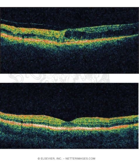 Watermarked preview of unlabeled image: Ocular Coherence Tomograms