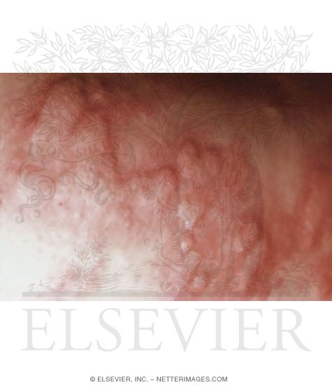 Watermarked preview of unlabeled image: Urticaria