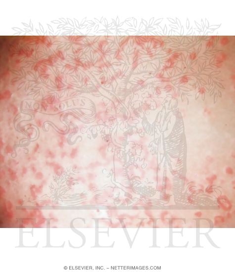 Watermarked preview of unlabeled image: Annular and Serpiginous Urticaria