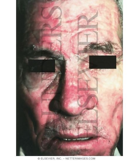 Watermarked preview of unlabeled image: Seborrheic Dermatitis