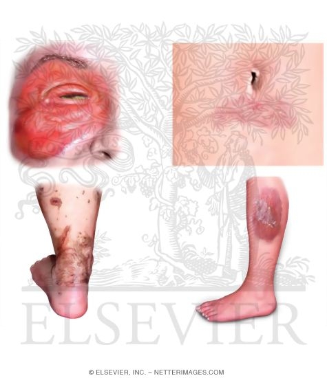 Watermarked preview of unlabeled image: Allergic Contact Dermatitis