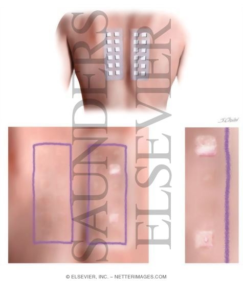 Watermarked preview of unlabeled image: Patch Test for Allertic Contact Dermatitis