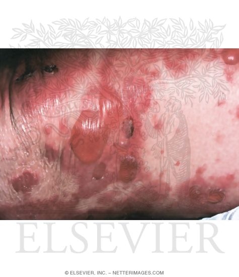 Watermarked preview of unlabeled image: Bullous Pemphigoid
