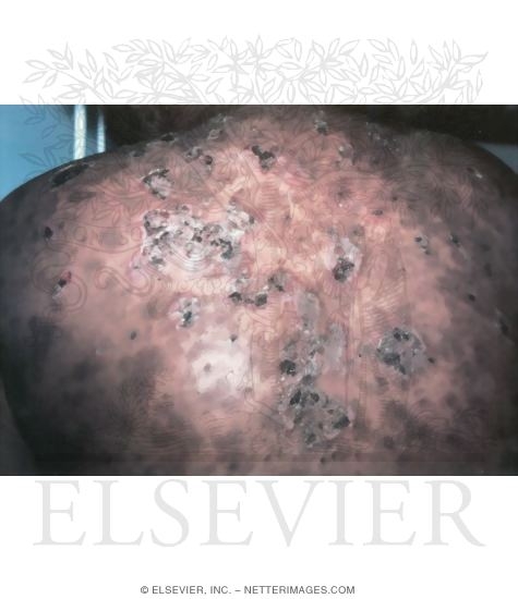 Watermarked preview of unlabeled image: Pemphigus Foliaceus