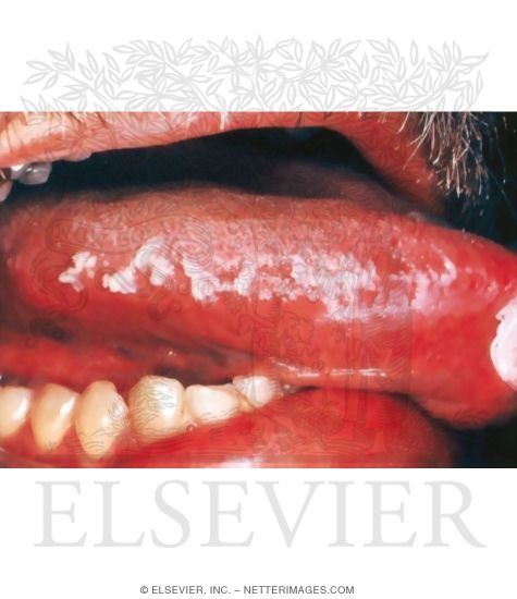 Hairy Leukoplakia of the Tongue